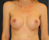 Feel Beautiful - Breast Augmentation 144 - After Photo